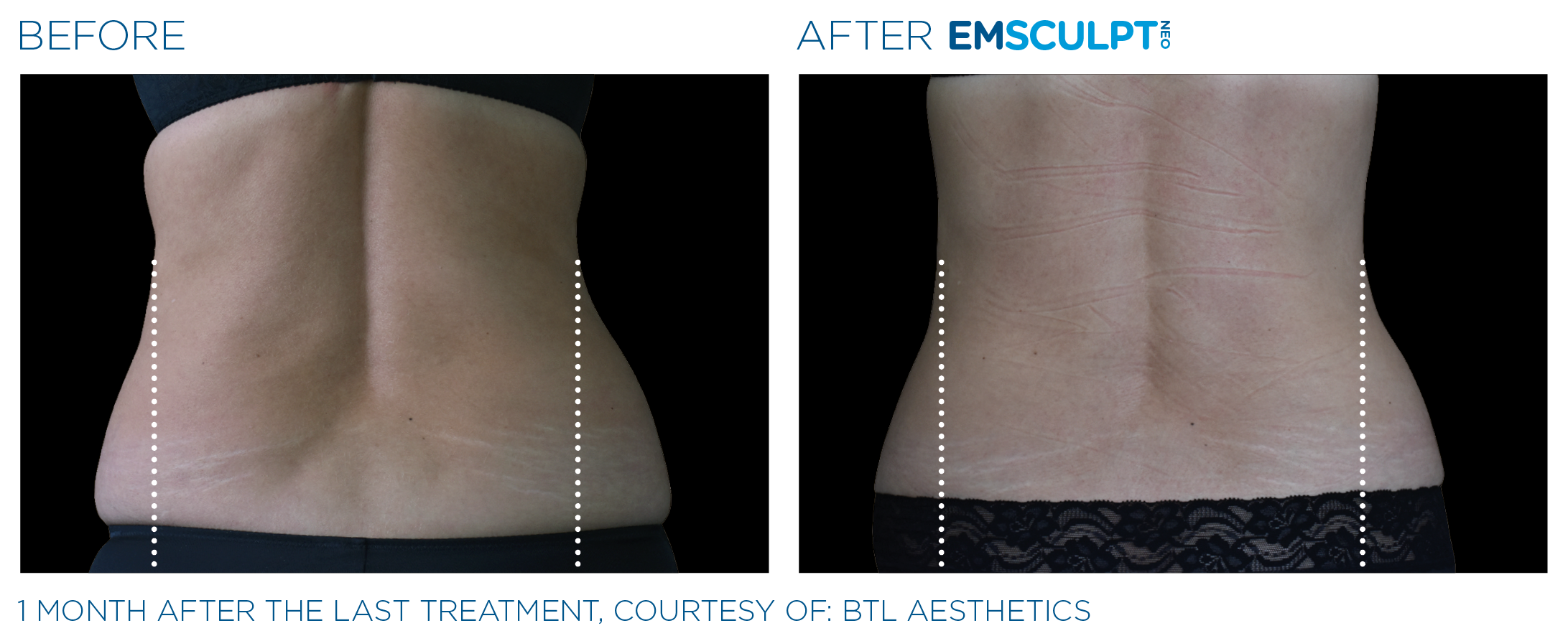 Emsculpt NEO More Muscle, Less Fat — Rejuve Medspa Newcastle near